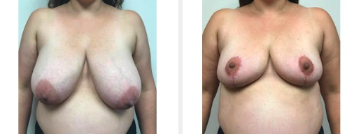 breast reduction paramus nj