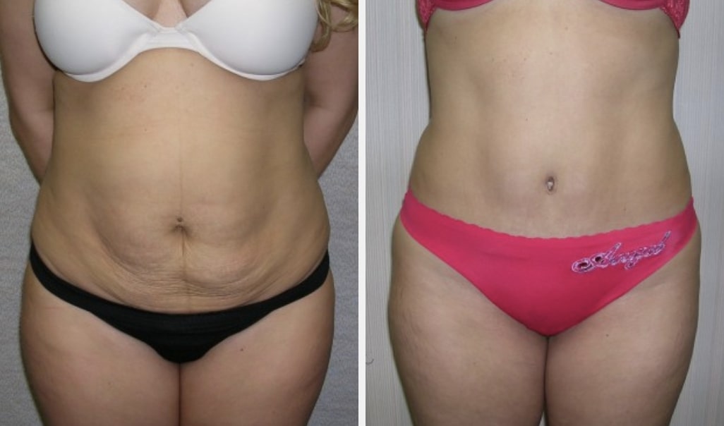 Abdominoplasty in Paramus, NJ, Tummy Tuck