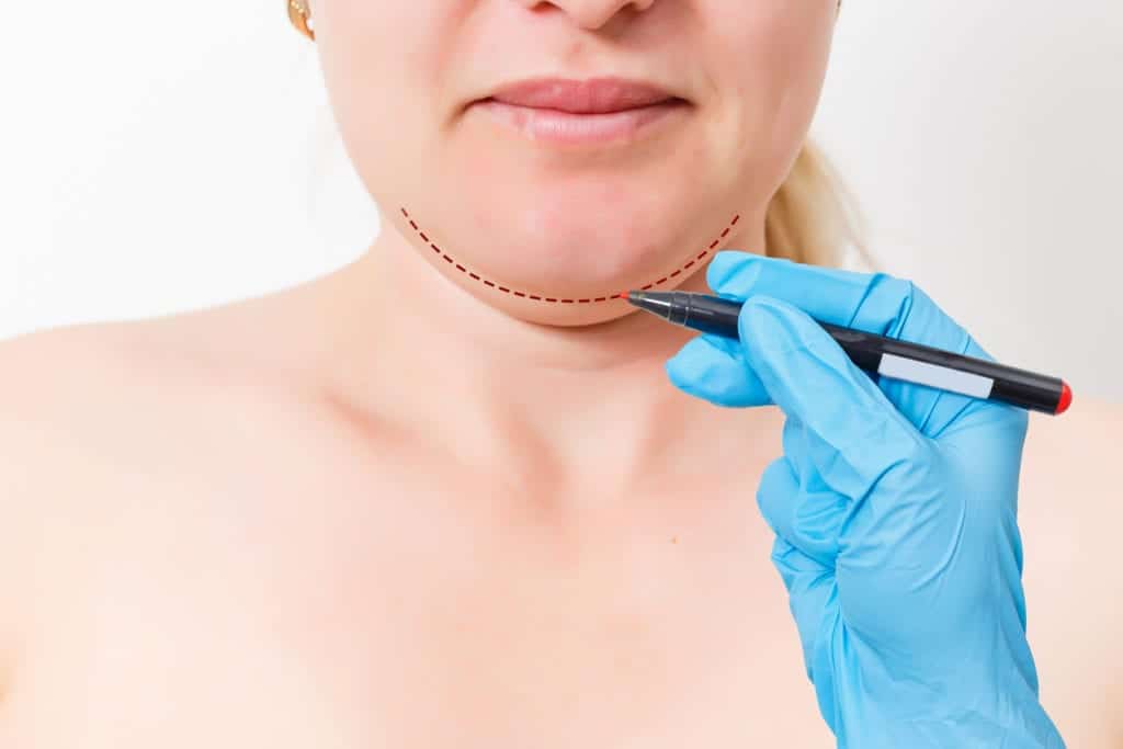 to medical professional’s hand in blue glove drawing dotted line on female patient’s chin preparing for augmentation