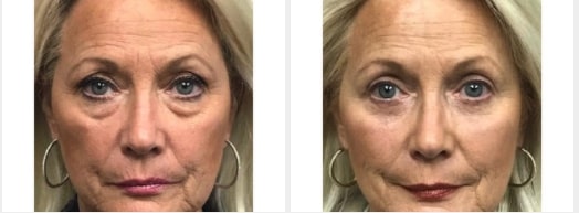 blepharoplasty before and after images plastic surgery specialists of new jersey