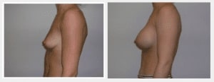 Plastic Surgery Specialists Of New Jersey before and after