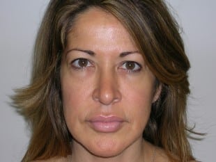 Botox treatment after image plastic surgery specialists of new jersey