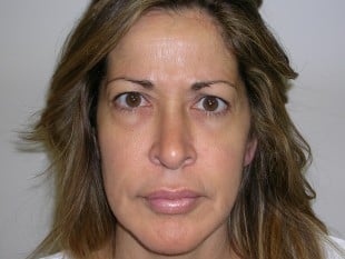 Botox treatment before image plastic surgery specialists of new jersey