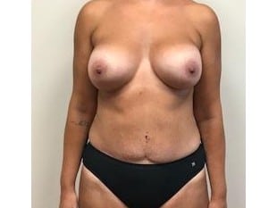 topless woman after mommy makeover, stomach flatter after procedure