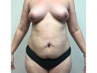 topless woman before mommy makeover procedure