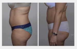 Liposuction Procedure before and after images