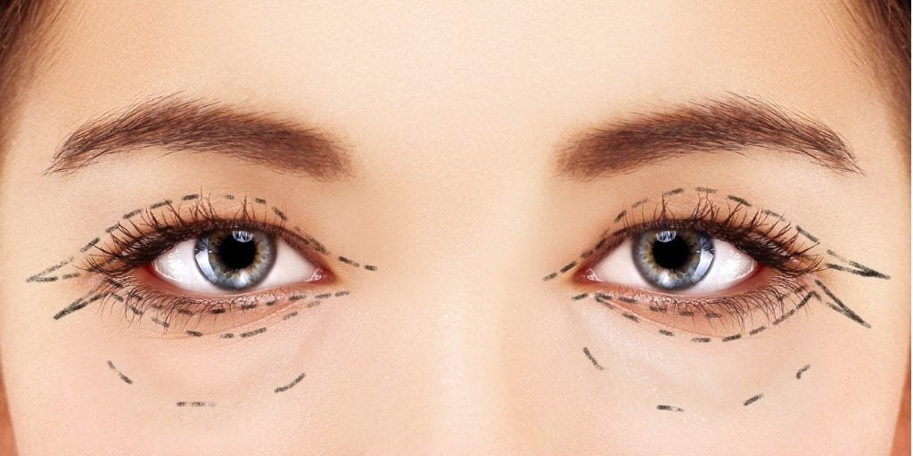 eyelid surgery