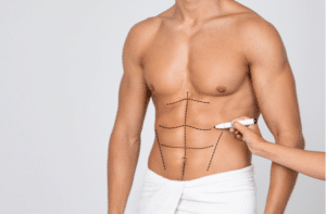 Mans Fit Torso With Surgical Lines On His Body Before Operation.