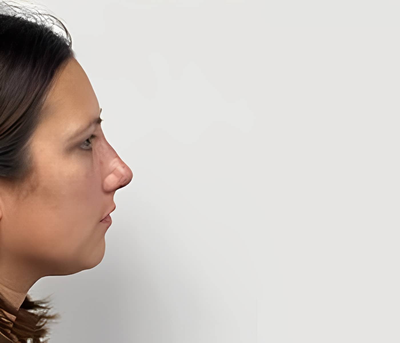 After Image: Rhinoplasty - right-side