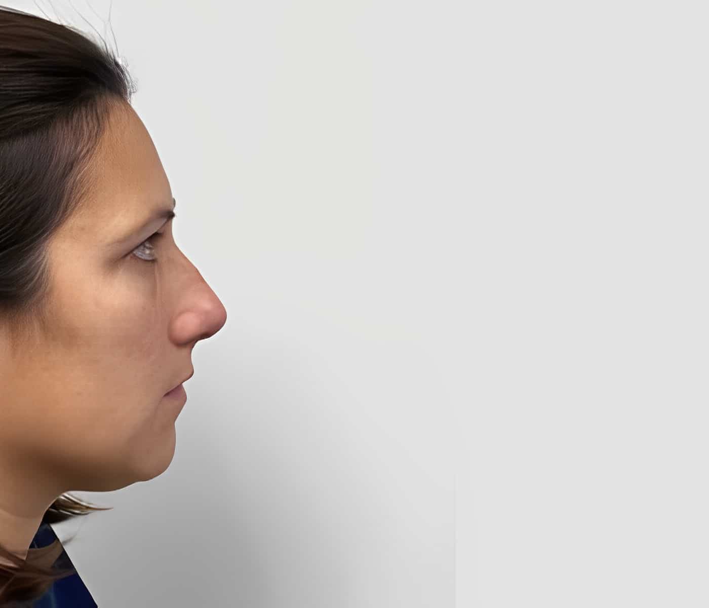 Before Image: Rhinoplasty - right-side
