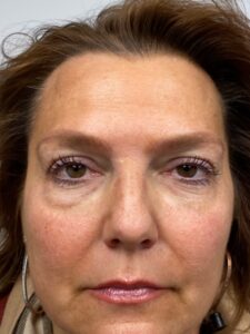 Blepharoplasty