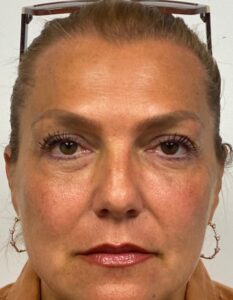 Blepharoplasty