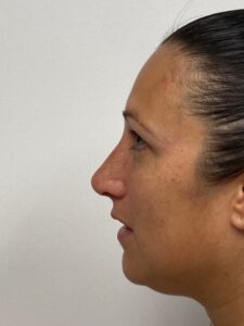 Rhinoplasty