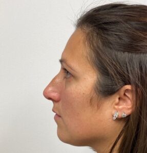 Rhinoplasty