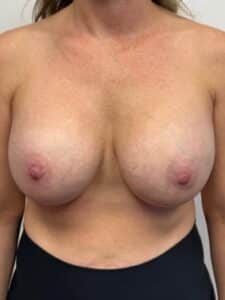 Breast Augmentation