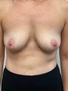 Breast Augmentation
