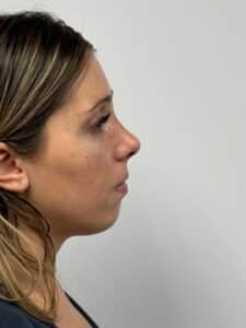 Rhinoplasty