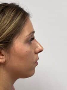 Rhinoplasty