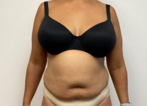 Abdominoplasty