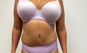 Abdominoplasty