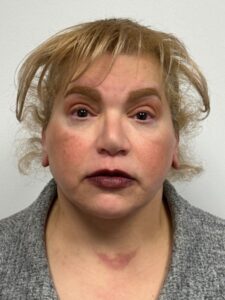 Facelift