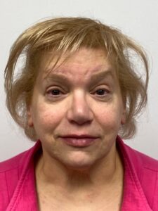 Facelift