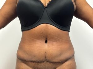Abdominoplasty