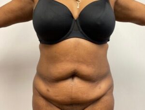 Abdominoplasty
