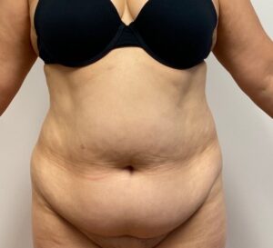 Abdominoplasty