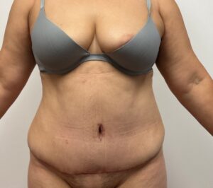 Abdominoplasty