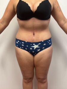Abdominoplasty and Liposuction