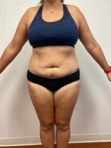 Abdominoplasty and Liposuction