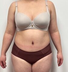 Abdominoplasty