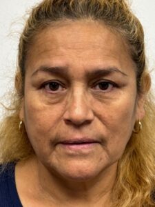 Before Image: Blepharoplasty