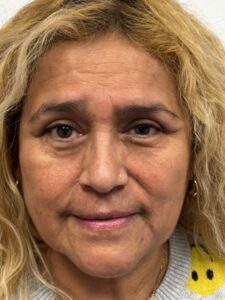 After Image: Blepharoplasty