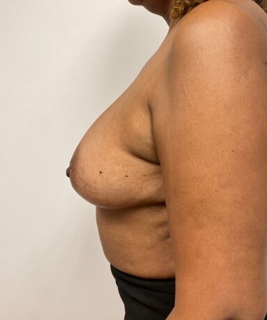 Before Image: Breast lift - 
