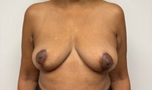 Breast lift