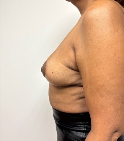 After Image: Breast lift - 