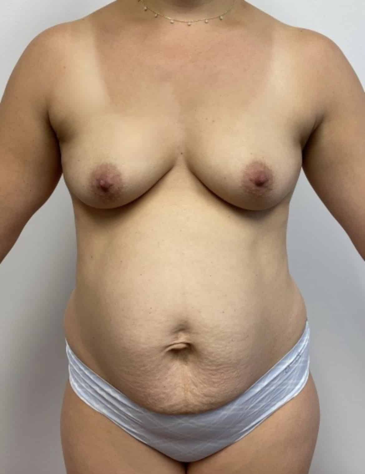 Before Image: Mommy Makeover - front