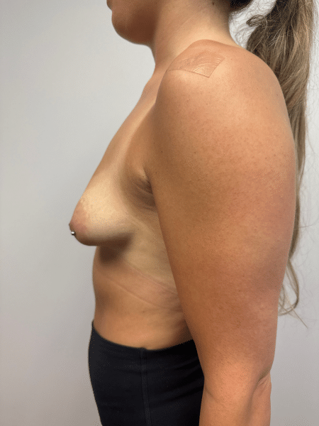 Before Image: breast augmentation - left-side