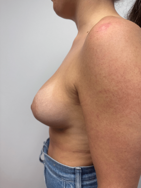 After Image: breast augmentation - left-side