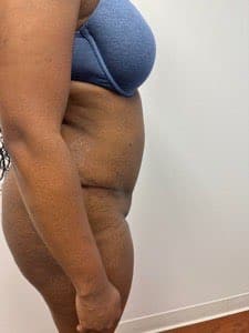 After Image: Abdominoplasty - right-side