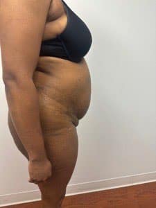 Before Image: Abdominoplasty - right-side