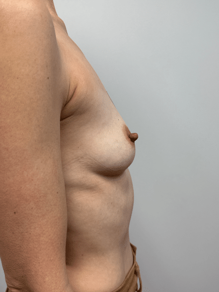 Before Image: Breast Augmentation -