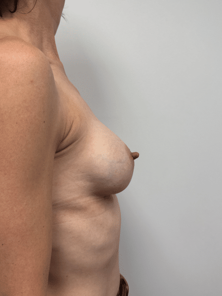 After Image: Breast Augmentation -