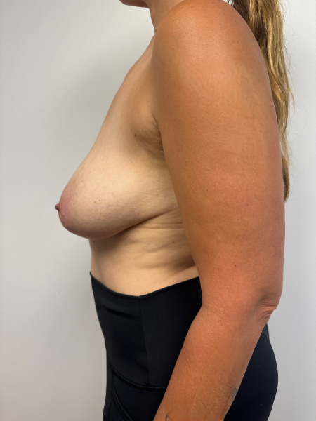 Before Image: Breast Lift - left-side