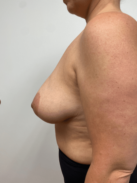 Before Image: Breast Lift and Reduction - left-side