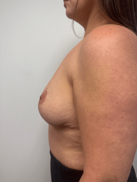 After Image: Breast Lift and Reduction - left-side