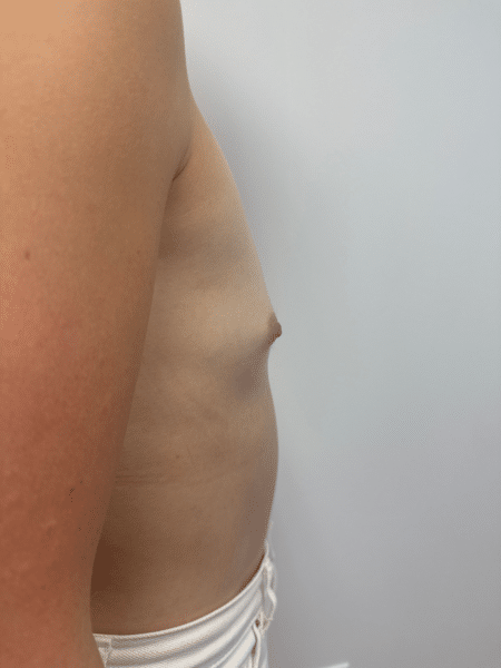 Before Image: Breast Augmentation - right-side