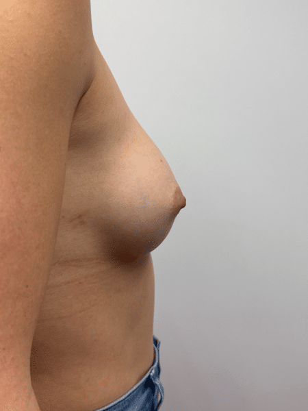 After Image: Breast Augmentation - right-side